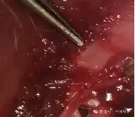 Posterior Semicircular Canal Drilling